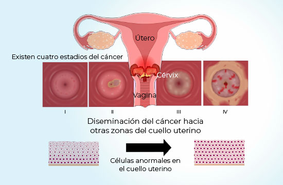 cancer-cervicouterino-cervix-blanco-coi-img1
