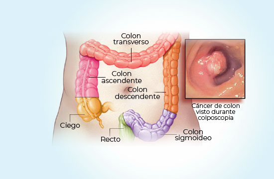 cancer-de-colon-coi-img1