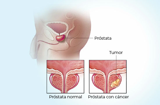 cancer-de-prostata-coi-img1