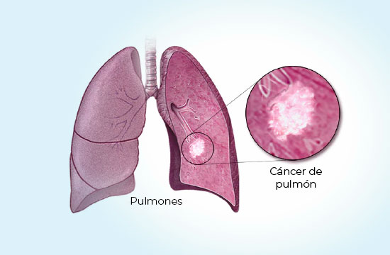 cancer-de-pulmon-coi-img1