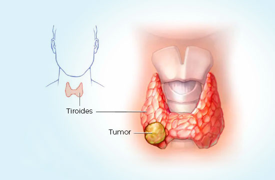 cancer-de-tiroides-coi-img1