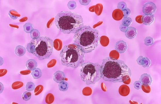 hematologia-coi-leucemia-img1