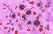 hematologia-coi-leucemia-img2